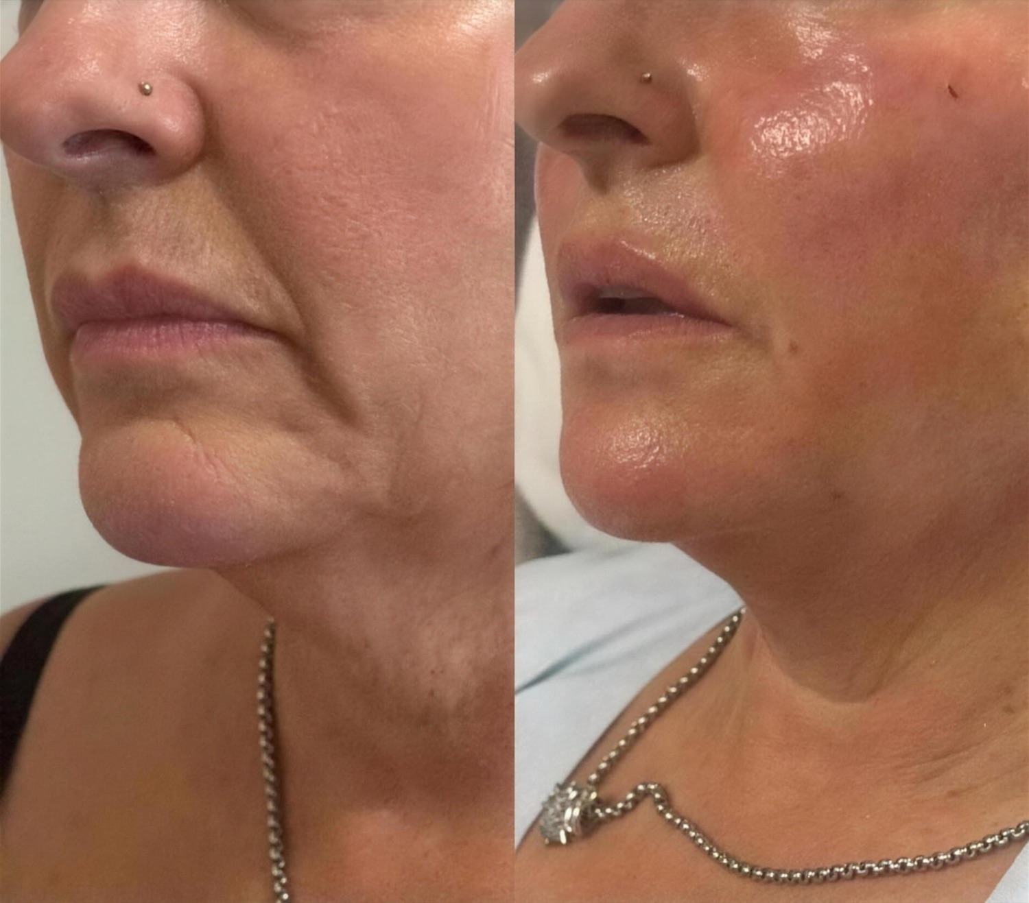 Before and after facial fat grafting: the lower face and jawline show restored volume and smoother contours